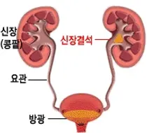 일부 경구용 항생제, 신장 결석 위험 높여
