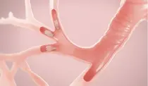 FDA, 중증 폐질환 치료 밸브 Zephyr 승인 