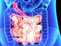 결장경 검사 전 '생체염료 복용' 정확도 높여