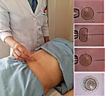 부산대병원 난임센터, 한방 침 이용한 여성난임 임상연구