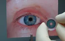 FDA, 최초 인공 홍채 '커스톰플렉스' 승인