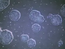줄기세포로 파킨슨병 치료… 일본서 첫 임상