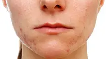 미국연구진, 여드름 치료 백신 개발..실험쥐 연구
