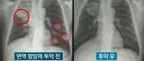고가 항암신약 치료 잘 되어도 급여안돼 투약 망설인다