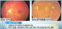 실명 당뇨병성 망막증 새 단서 발견