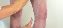 키 클수록 하지정맥류 위험 높아