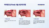 올림푸스한국, 아이틴드(iTind) 출시