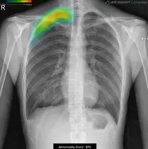 루닛 인사이트 CXR, 폐 질환 진단 보조 AI 최초로 식약처 혁신의료기기 지정