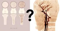뼈 밀도가 뇌혈관질환과 상관 관련 규명