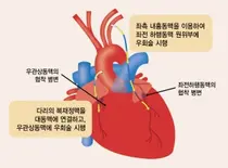 강동경희대병원, 꺼져가는 심장에 새 활로 열어주는 관상동맥 우회술
