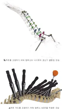 FDA, 척추 임플란트 기기 ‘어드밴스드 럼픽스’ 승인