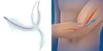 메드트로닉 약물방출 풍선카테터, 말기 신장질환 투석혈관 치료 보험급여 