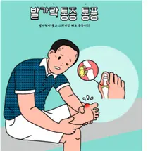의정부을지대병원, '통풍' 완화 방법 제시