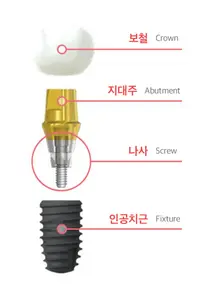 강동경희대병원, 잘 씹히는 튼튼한 임플란트 위한 5가지 조건