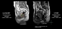 엘렉타코리아, 국내 최초 1.5T MR-LINAC 방사선 치료기 유니티 출시 기자간담회
