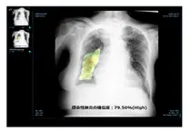 제이엘케이, 인공지능 (AI) 폐질환 솔루션 일본 PMDA 인허가 획득