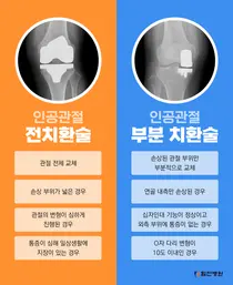 내 관절 보존하고 닳을 관절만 바꿔주는 인공관절 부분치환술