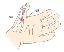 강동경희대병원, 손가락에서 ‘딸깍’? ‘방아쇠 손가락