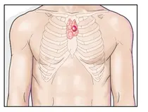 고대구로, 면역세포 만드는 '흉선' 퇴화하지 않으면 '흉선암'의 원인