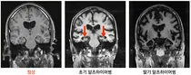 법원, 당국 '콜린' 선별처방 '집행정지' 결정 