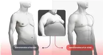 한미약품, 글로벌 비만신약 FDA에 임상 1상 IND 신청