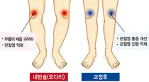 강동경희대병원, 관절염으로 변형된 오다리, 교정술 필요한 이유는?