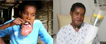 서울아산병원,‘혹 달린 아이’ 따돌림받던 청년 한국서 미소 되찾아