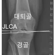 서울대병원, 무릎 퇴행성 관절염 가속 진행 예측 지표 확인