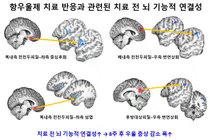청소년 우울증 항우울제 치료 반응, 치료 전 ‘뇌 기능적 연결성’ 예측