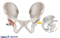서울대병원, MAKO 로봇 활용 인공고관절 재치환술 국내 최초 시행