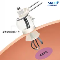 몸속 좁아 어려운 ‘소아 단일공 로봇수술’, 국내 최초 다기관 연구로 안전성 확인