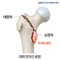 고관절 골절, 불안정한 경우에도 골절 부위 정확히 맞추면 수술 결과 좋아