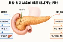 췌장 수술, 생존 넘어 ‘대사질환’ 예방으로 패러다임 전환
