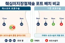 고난도 로봇 췌십이지장절제술,  절개구멍 줄이면서 수술시간 단축한다