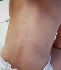 고대구로, 계속되는 폭염 열 많은 우리아이 땀띠 예방하려면?