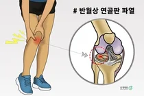 날개병원, 젊은 연령층에 흔한 무릎통증, 반월상 연골판 손상