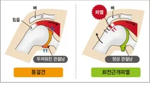강동경희대병원, 어깨관절의날 어깨통증 원인 바로 알기