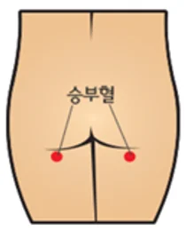 경희의료원 척추관협착증,승부혈로 승부하라