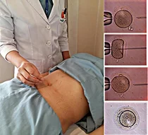 부산대병원 난임센터, 한방 침 이용한 여성난임 임상연구