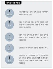 상계백병원, 검버섯인줄 알았는데...피부암?
