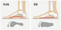 강동경희대병원, 평발인 우리아이 교정 꼭 필요할까?