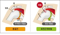 강동경희대병원, 밤잠 설치는 어깨통증... 무관심이 병 키운 탓