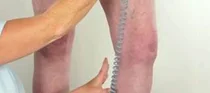키 클수록 하지정맥류 위험 높아