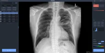 뷰노, '흉부 X-ray 솔루션' 대만 의료시장 본격 진출