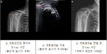 한림대동탄성심, 응급실까지 찾는 석회성건염…최근 5년간 환자수 29% 증가