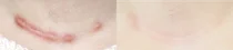 일산병원, 흉터성형레이저클리닉 개소