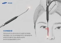강북삼성병원, 시도때도 없이 흘리는 눈물 '누도미세내시경'으로 치료
