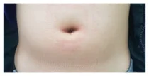 고대안산, 배가 전체적으로 아플 수 있는 소아 충수염