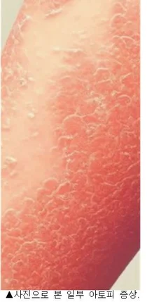 아토피 '교차투여' 급여약가 자진 인하안 제출