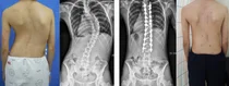 청소년기 척추측만증 환자에서 최소침습수술 우수성 입증